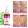 AHA serum